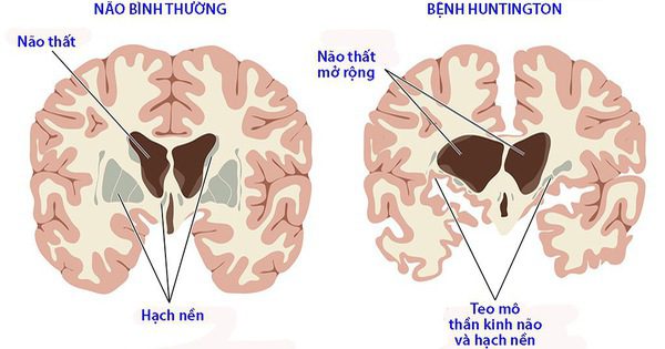 Bệnh Huntington: Sinh lý bệnh, chẩn đoán và điều trị