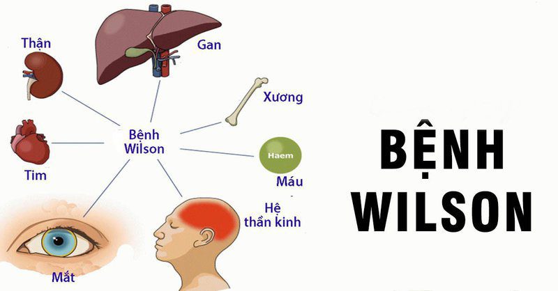 Bệnh Wilson chẩn đoán và điều trị