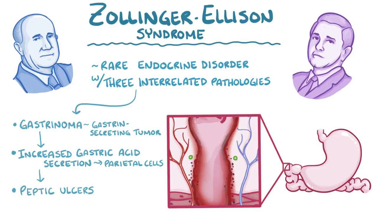 Quản lý và tiên lượng hội chứng Zollinger-Ellison (U tiết gastrin)