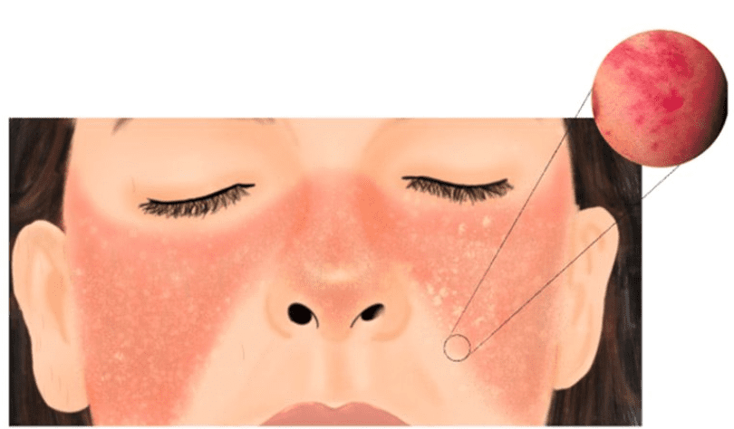 Bệnh lupus ban đỏ hệ thống (SLE)