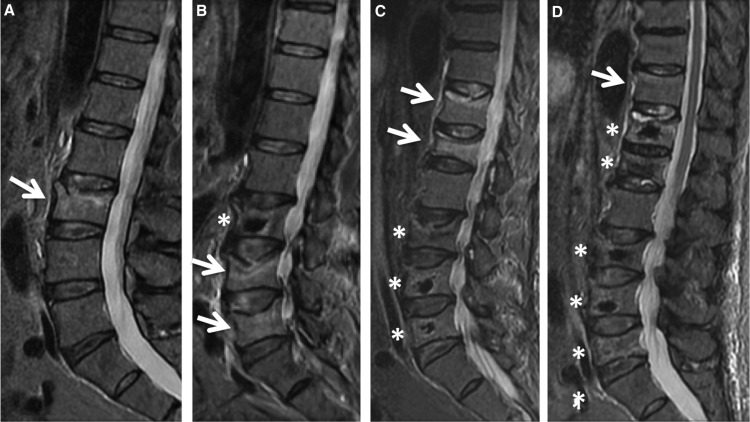 Bài giảng loãng xương dành cho sau đại học