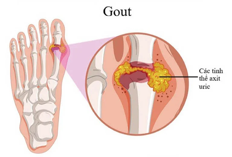 Cập nhật chẩn đoán và điều trị bệnh Gout dựa trên bằng chứng