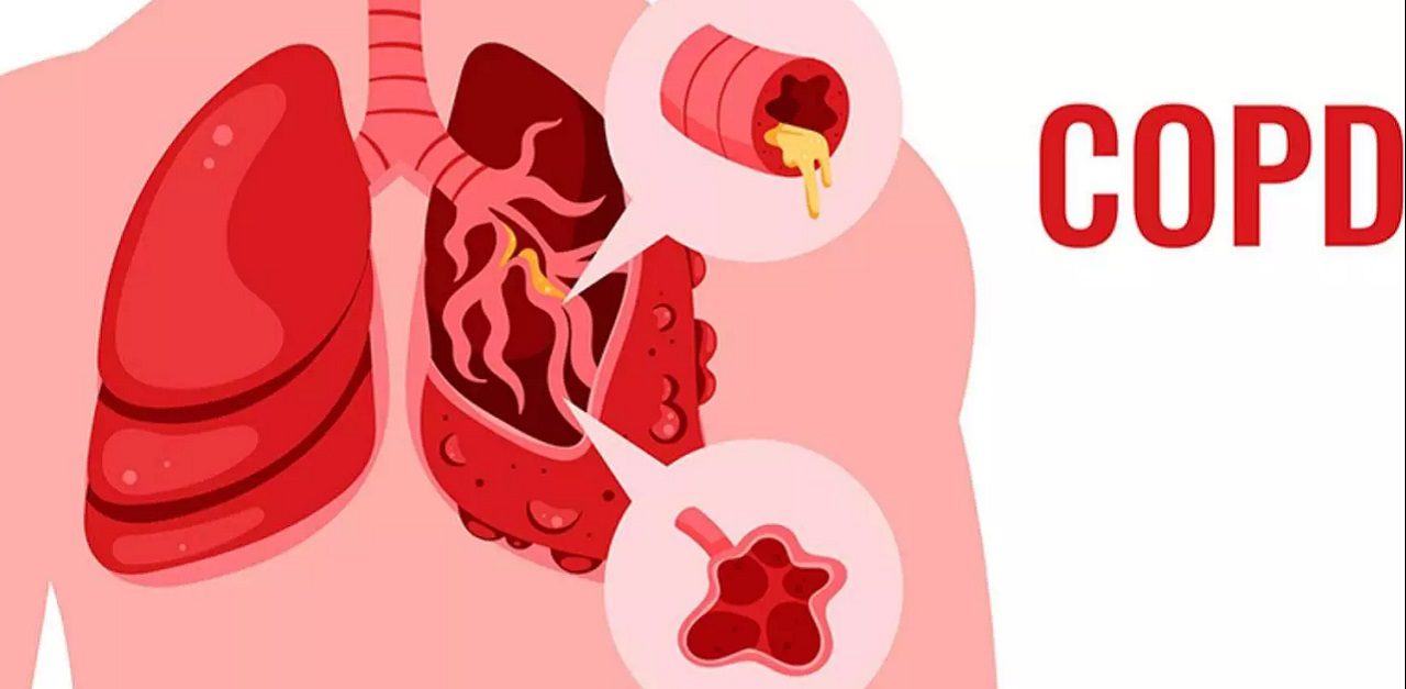 Bệnh phổi tắc nghẽn mãn tính (COPD): Bài giảng dành cho sau đại học