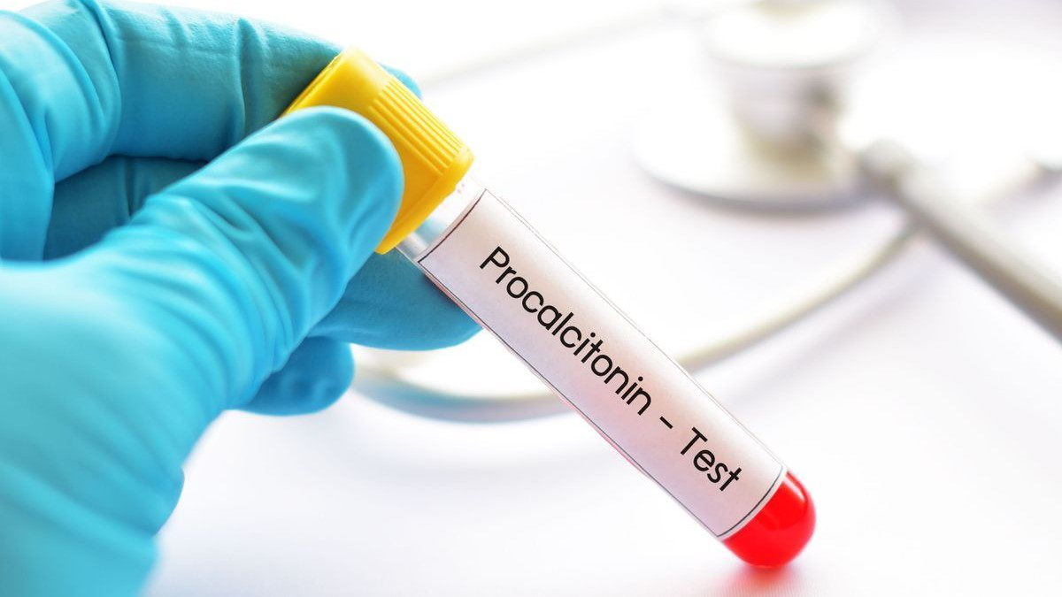 Xét nghiệm procalcitonin: nguyên lý và ứng dụng trên lâm sàng Xét nghiệm procalcitonin: nguyên lý và ứng dụng trên lâm sàng