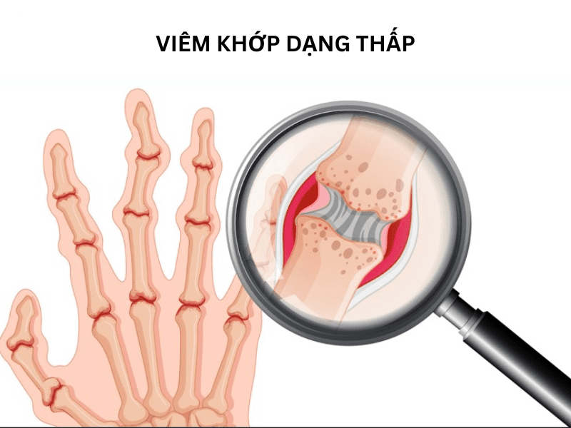 Bài giảng Viêm khớp dạng thấp dành cho sau đại học