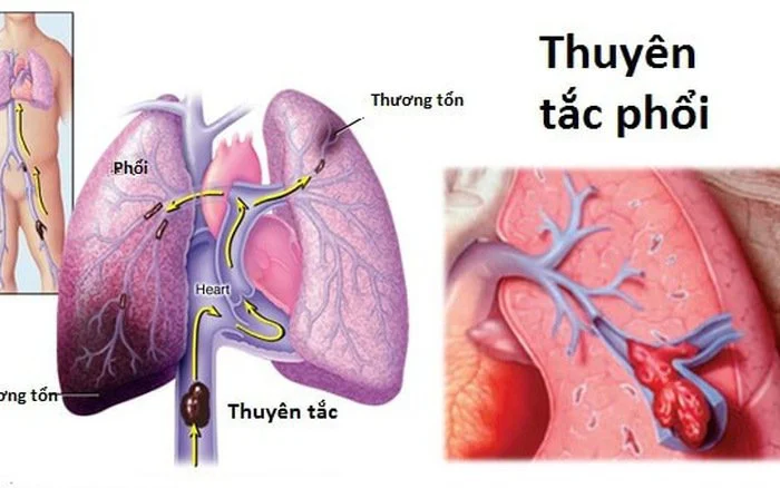 Thuyên tắc phổi: Dịch tễ học, Sinh lý bệnh, Chẩn đoán, Quản lý và Phòng ngừa