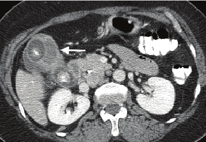[Sách dịch] Sổ tay Bệnh Gan. CHƯƠNG CUỐI (36). CÁC KHỐI U ĐƯỜNG MẬT