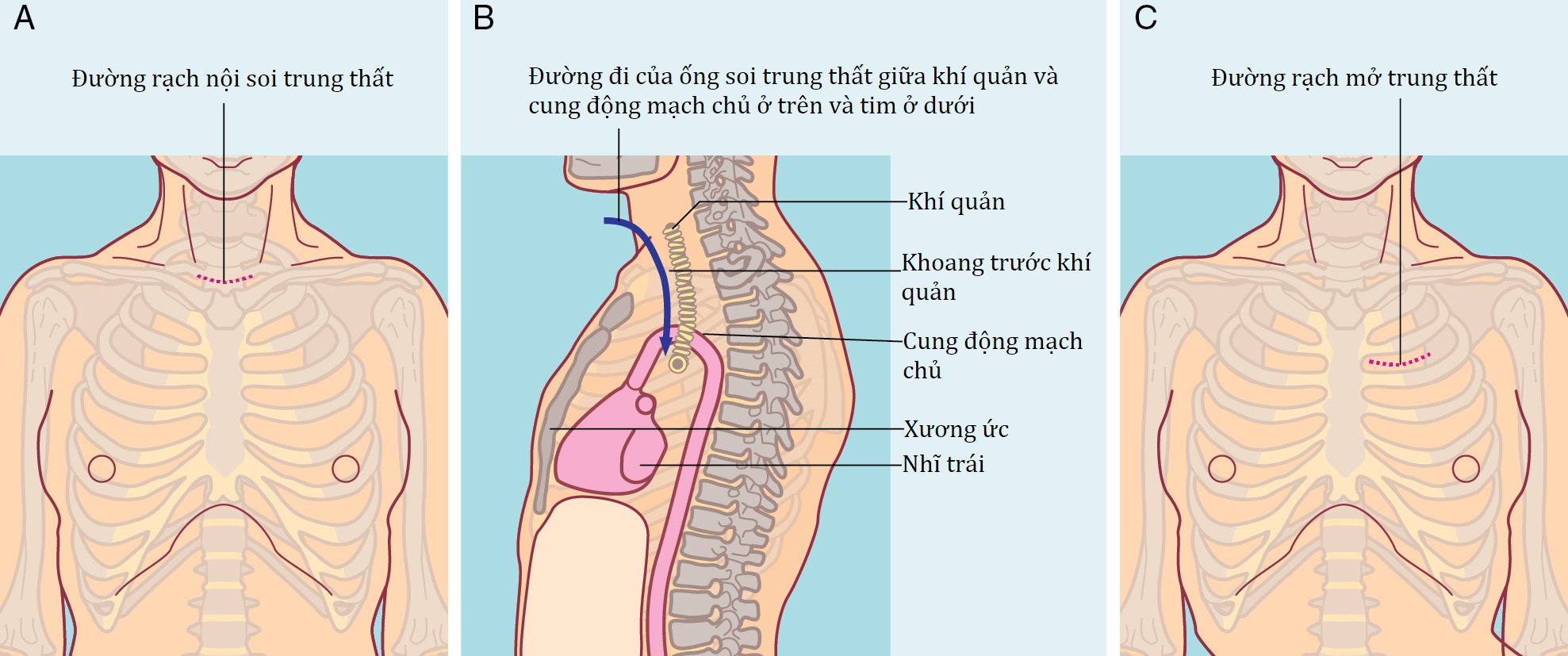 Ngoại khoa Căn bản: Vấn đề, Chẩn đoán và Quản lý, Ấn bản thứ 7 (2026). CHƯƠNG 31. PHẪU THUẬT LỒNG NGỰC (NGOẠI TRỪ TIM)