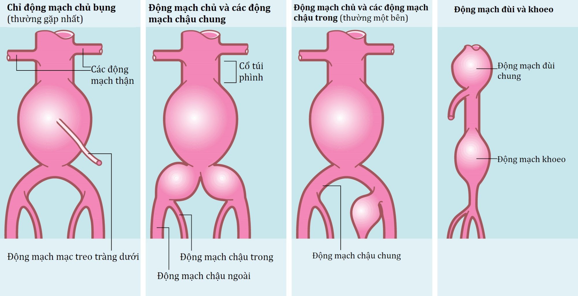 Ngoại khoa Căn bản: Vấn đề, Chẩn đoán và Quản lý, Ấn bản thứ 7 (2026). CHƯƠNG 41. Phình động mạch và các rối loạn động mạch ngoại vi khác