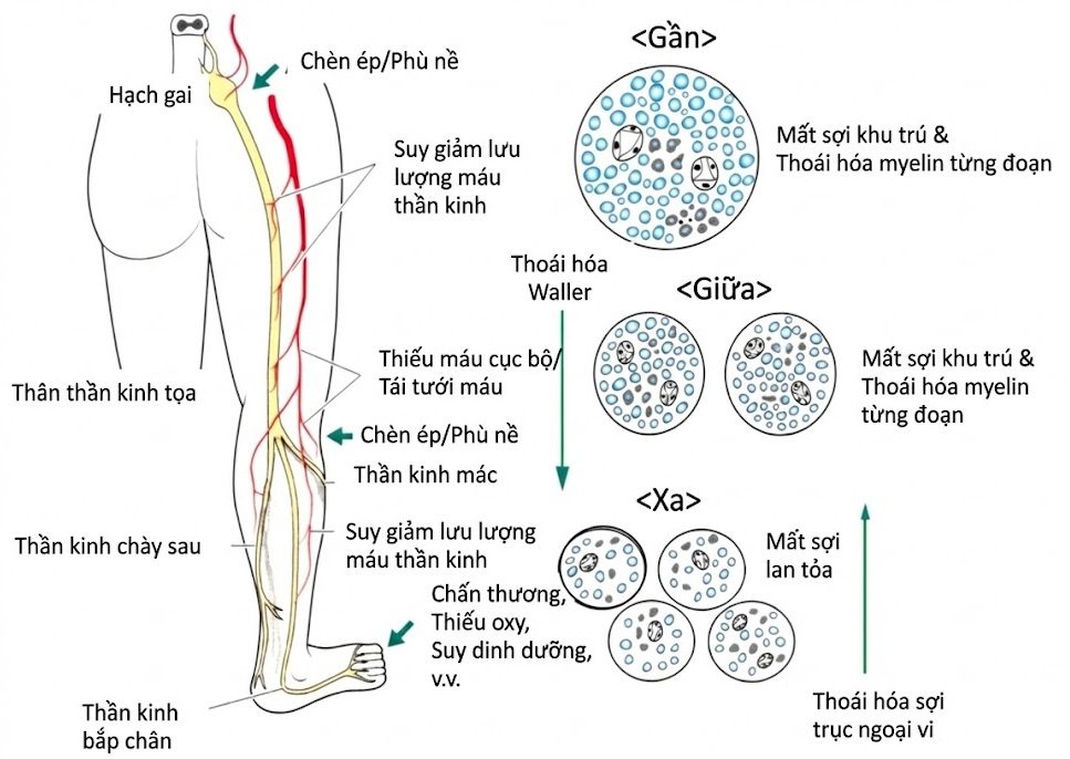 Bệnh lý Thần kinh Đái tháo đường. CHƯƠNG 2. CƠ SỞ BỆNH HỌC CỦA BỆNH LÝ THẦN KINH ĐÁI THÁO ĐƯỜNG Ở NGƯỜI
