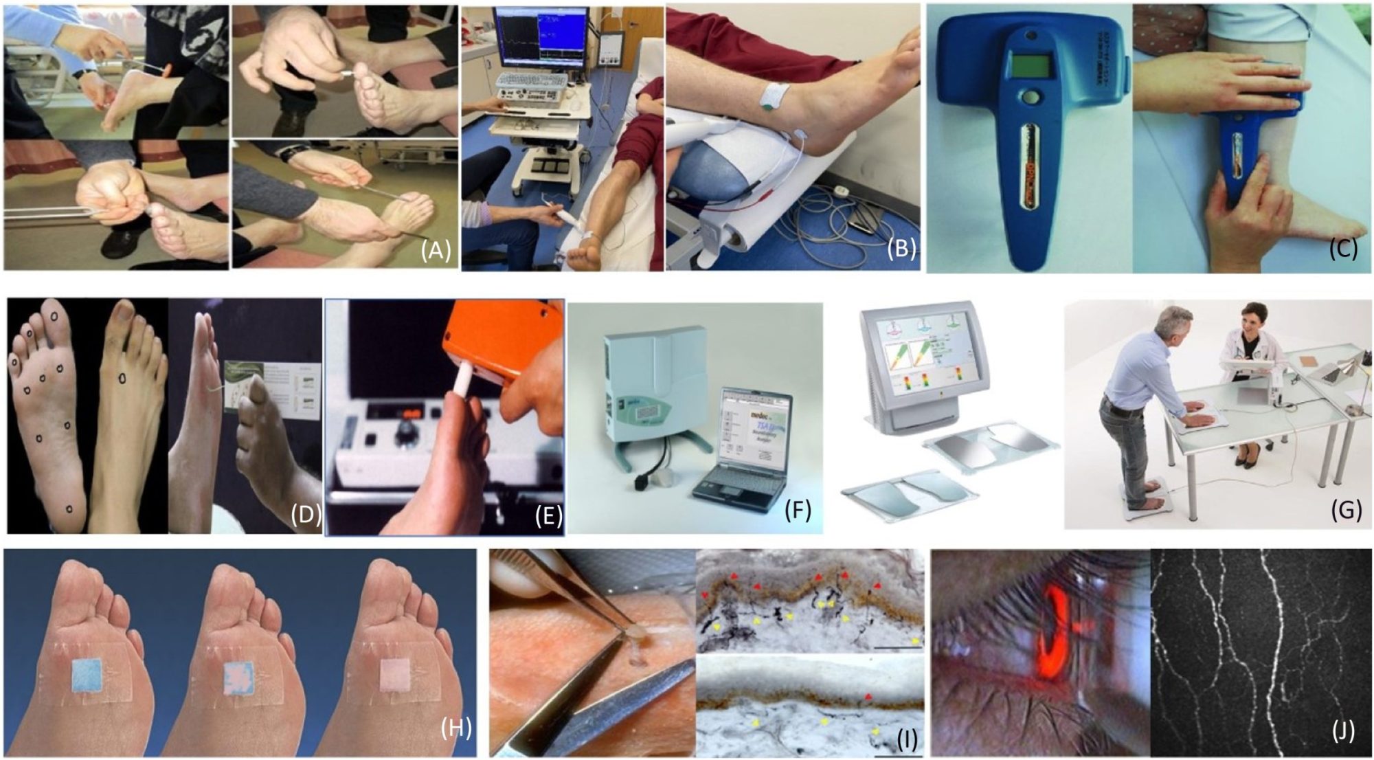 Bệnh lý Thần kinh Đái tháo đường. CHƯƠNG 4. NHỮNG TIẾN BỘ TRONG SÀNG LỌC, CHẨN ĐOÁN SỚM VÀ PHÂN GIAI ĐOẠN CHÍNH XÁC BỆNH LÝ THẦN KINH ĐÁI THÁO ĐƯỜNG