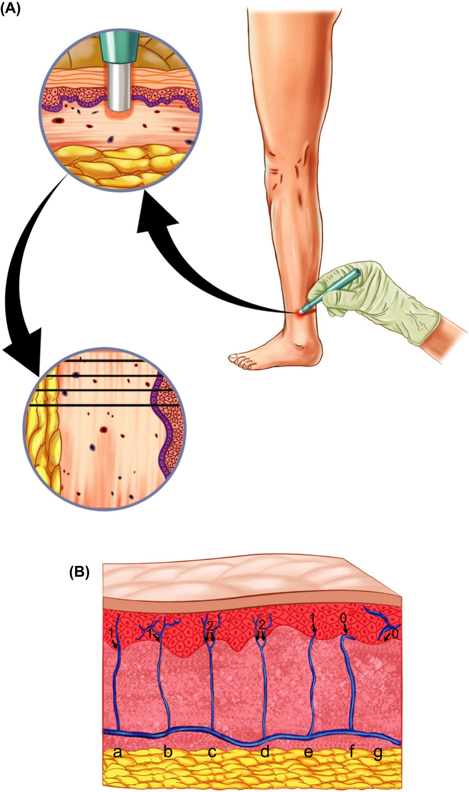 Bệnh lý Thần kinh Đái tháo đường. CHƯƠNG 5. PHÂN TÍCH SINH THIẾT DA TRONG BỆNH LÝ THẦN KINH ĐÁI THÁO ĐƯỜNG Bệnh lý Thần kinh Đái tháo đường. CHƯƠNG 5. PHÂN TÍCH SINH THIẾT DA TRONG BỆNH LÝ THẦN KINH ĐÁI THÁO ĐƯỜNG