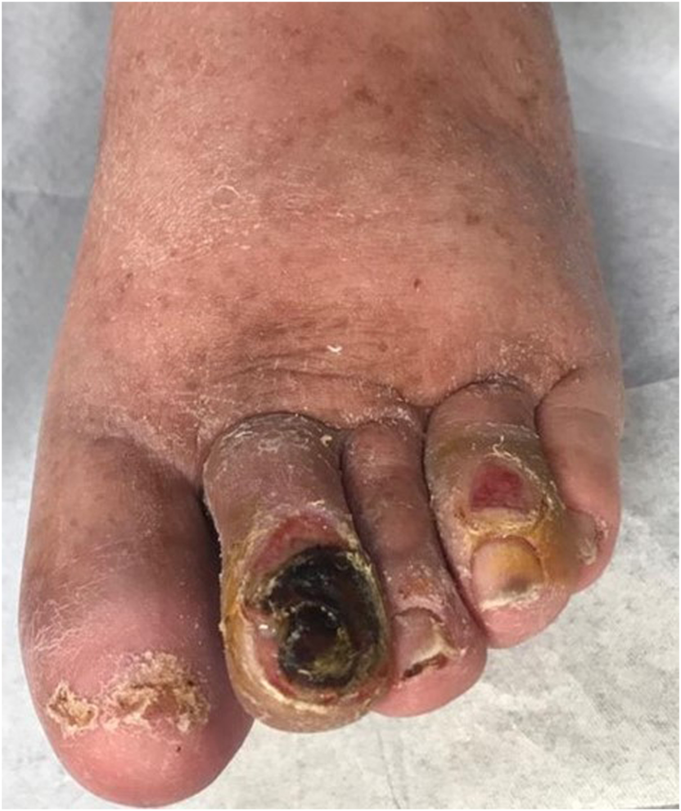 Bệnh lý Thần kinh Đái tháo đường. CHƯƠNG 14. BỆNH LÝ BÀN CHÂN ĐÁI THÁO ĐƯỜNG Bệnh lý Thần kinh Đái tháo đường. CHƯƠNG 14. BỆNH LÝ BÀN CHÂN ĐÁI THÁO ĐƯỜNG