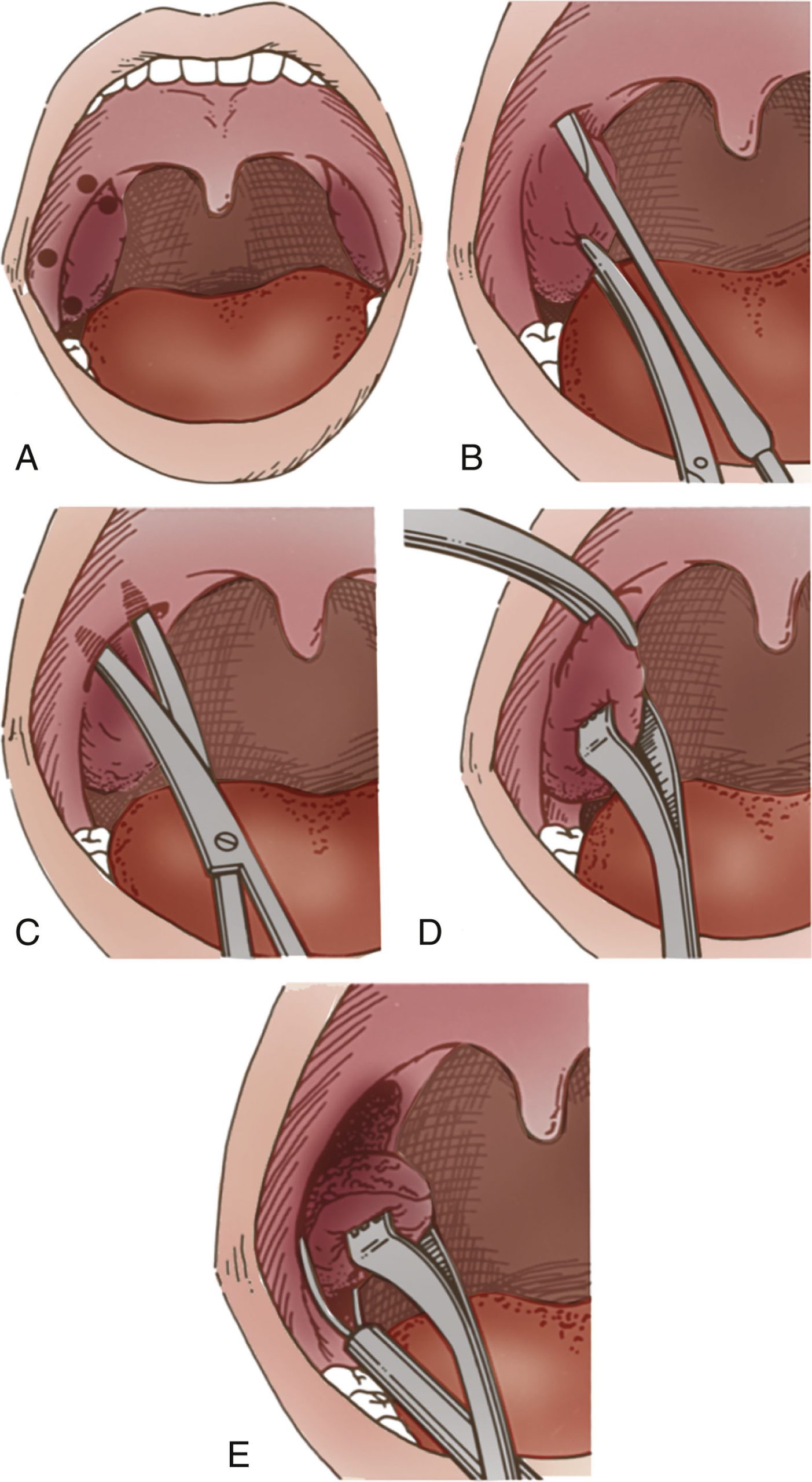 Sổ tay Tai Mũi Họng – Phẫu thuật Đầu Cổ (2026). PHỤ LỤC A. CÁC THỦ THUẬT CƠ BẢN VÀ PHƯƠNG PHÁP THĂM DÒ Sổ tay Tai Mũi Họng – Phẫu thuật Đầu Cổ (2026). PHỤ LỤC A. CÁC THỦ THUẬT CƠ BẢN VÀ PHƯƠNG PHÁP THĂM DÒ