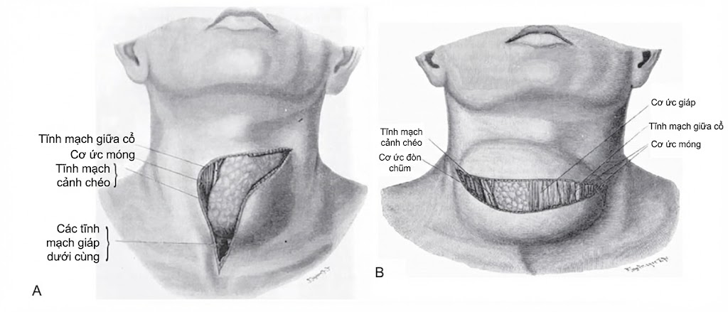 PHẪU THUẬT TUYẾN GIÁP VÀ TUYẾN CẬN GIÁP, ẤN BẢN THỨ 3. Chương 40. CÁC ĐƯỜNG MỔ TRONG PHẪU THUẬT TUYẾN GIÁP VÀ TUYẾN CẬN GIÁP PHẪU THUẬT TUYẾN GIÁP VÀ TUYẾN CẬN GIÁP, ẤN BẢN THỨ 3. Chương 40. CÁC ĐƯỜNG MỔ TRONG PHẪU THUẬT TUYẾN GIÁP VÀ TUYẾN CẬN GIÁP