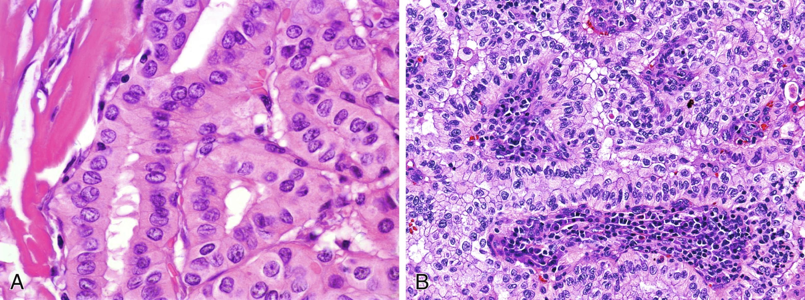 PHẪU THUẬT TUYẾN GIÁP VÀ TUYẾN CẬN GIÁP, ẤN BẢN THỨ 3. CHƯƠNG 41: GIẢI PHẪU BỆNH HỌC NGOẠI KHOA CỦA TUYẾN GIÁP PHẪU THUẬT TUYẾN GIÁP VÀ TUYẾN CẬN GIÁP, ẤN BẢN THỨ 3. CHƯƠNG 41: GIẢI PHẪU BỆNH HỌC NGOẠI KHOA CỦA TUYẾN GIÁP