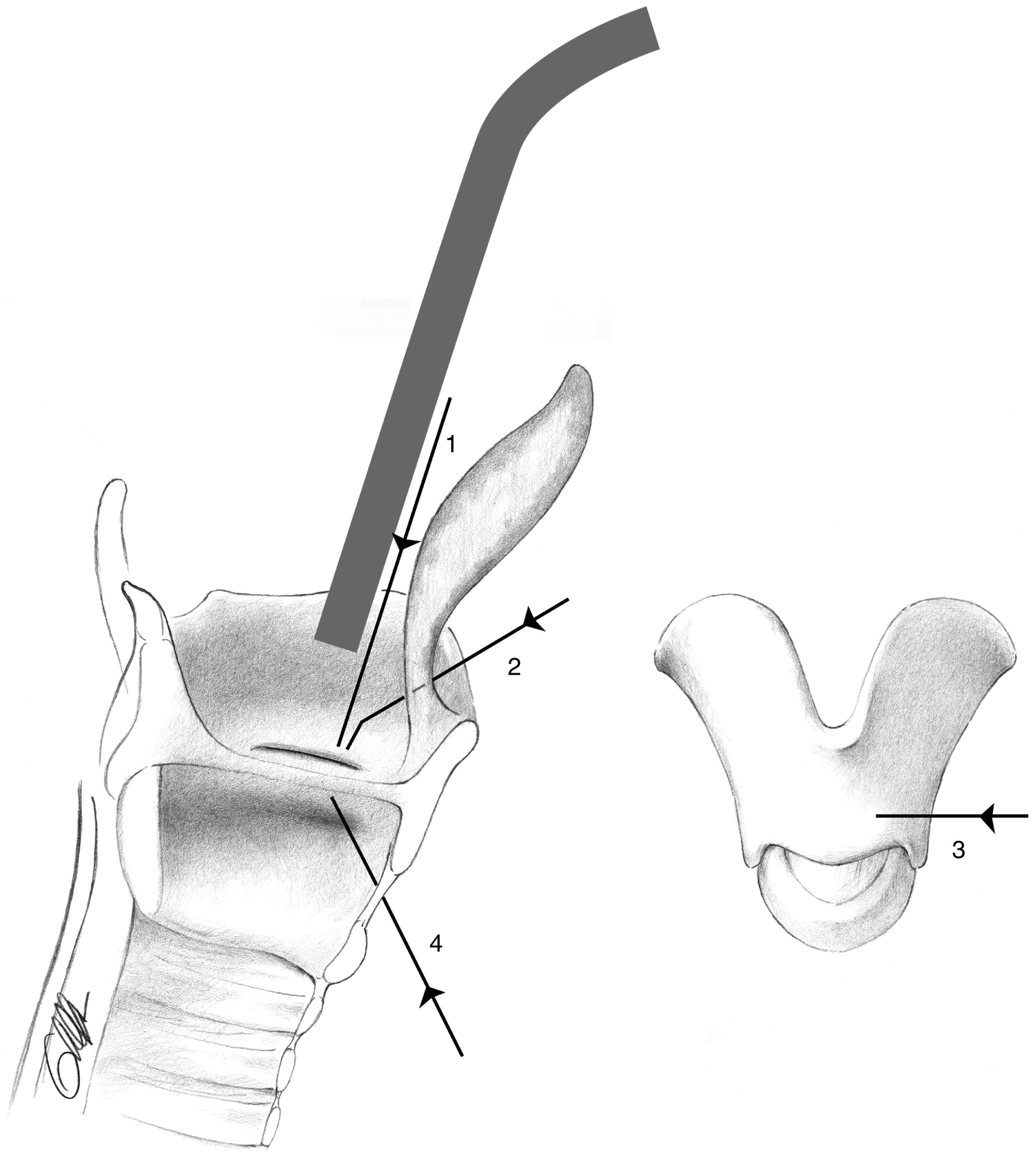 PHẪU THUẬT TUYẾN GIÁP VÀ TUYẾN CẬN GIÁP, ẤN BẢN THỨ 3. CHƯƠNG 43. XỬ TRÍ LIỆT THẦN KINH THANH QUẢN QUẶT NGƯỢC PHẪU THUẬT TUYẾN GIÁP VÀ TUYẾN CẬN GIÁP, ẤN BẢN THỨ 3. CHƯƠNG 43. XỬ TRÍ LIỆT THẦN KINH THANH QUẢN QUẶT NGƯỢC