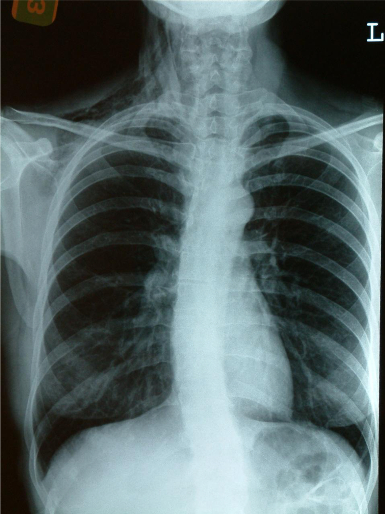 PHẪU THUẬT TUYẾN GIÁP VÀ TUYẾN CẬN GIÁP, ẤN BẢN THỨ 3. CHƯƠNG 44. CÁC BIẾN CHỨNG KHÔNG THUỘC THẦN KINH TRONG PHẪU THUẬT TUYẾN GIÁP VÀ TUYẾN CẬN GIÁP PHẪU THUẬT TUYẾN GIÁP VÀ TUYẾN CẬN GIÁP, ẤN BẢN THỨ 3. CHƯƠNG 44. CÁC BIẾN CHỨNG KHÔNG THUỘC THẦN KINH TRONG PHẪU THUẬT TUYẾN GIÁP VÀ TUYẾN CẬN GIÁP