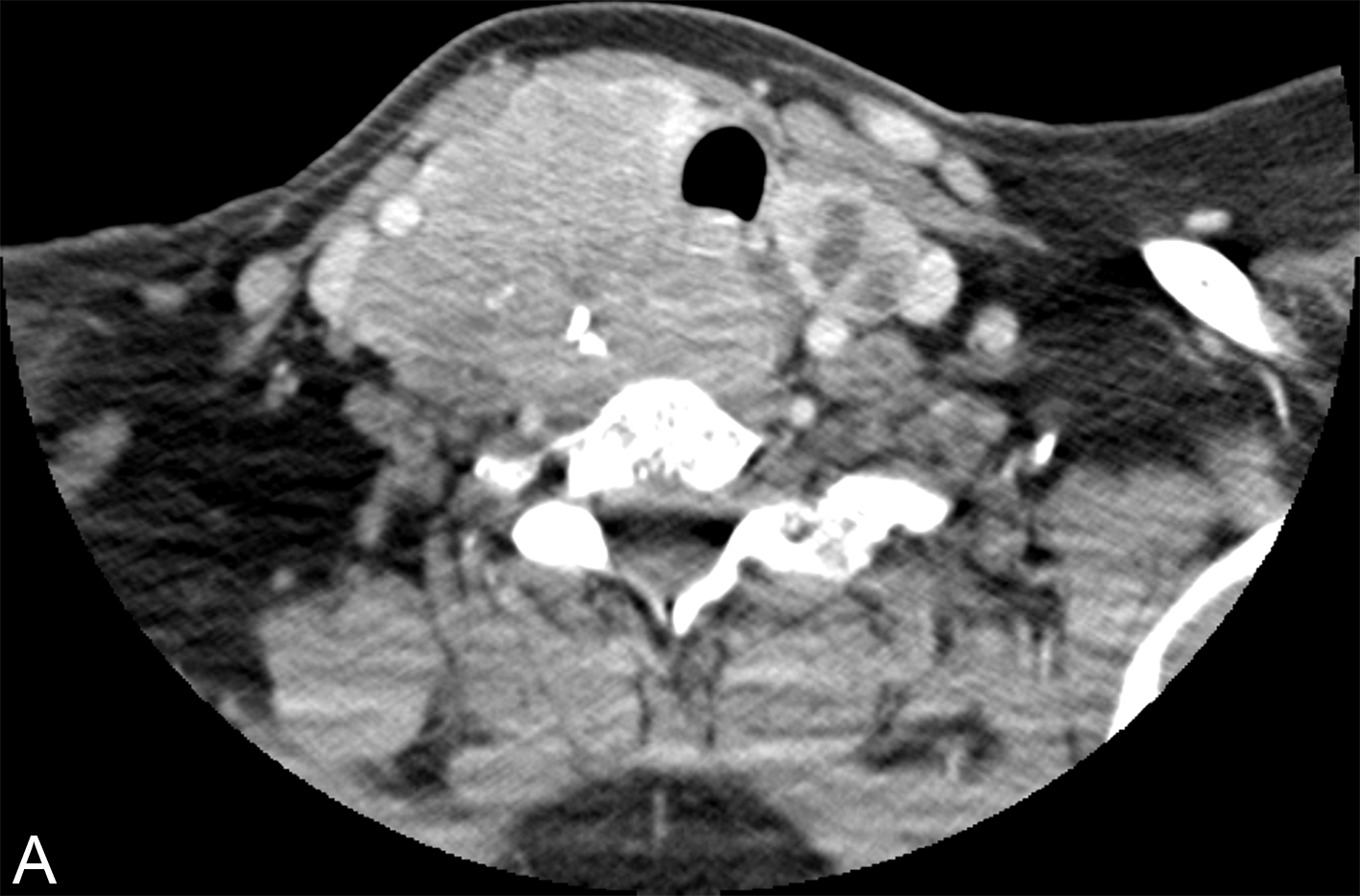 PHẪU THUẬT TUYẾN GIÁP VÀ TUYẾN CẬN GIÁP, ẤN BẢN THỨ 3. CHƯƠNG 49. XẠ TRỊ CHIẾU NGOÀI CHO CÁC BỆNH LÝ ÁC TÍNH TUYẾN GIÁP PHẪU THUẬT TUYẾN GIÁP VÀ TUYẾN CẬN GIÁP, ẤN BẢN THỨ 3. CHƯƠNG 49. XẠ TRỊ CHIẾU NGOÀI CHO CÁC BỆNH LÝ ÁC TÍNH TUYẾN GIÁP