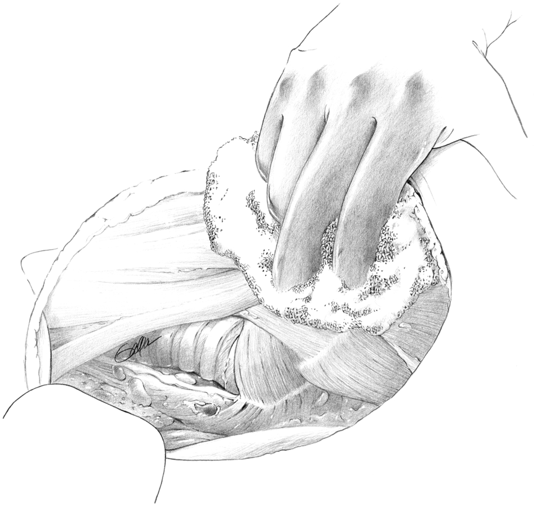 PHẪU THUẬT TUYẾN GIÁP VÀ TUYẾN CẬN GIÁP, ẤN BẢN THỨ 3. CHƯƠNG 50. PHẪU THUẬT LẠI TUYẾN GIÁP PHẪU THUẬT TUYẾN GIÁP VÀ TUYẾN CẬN GIÁP, ẤN BẢN THỨ 3. CHƯƠNG 50. PHẪU THUẬT LẠI TUYẾN GIÁP