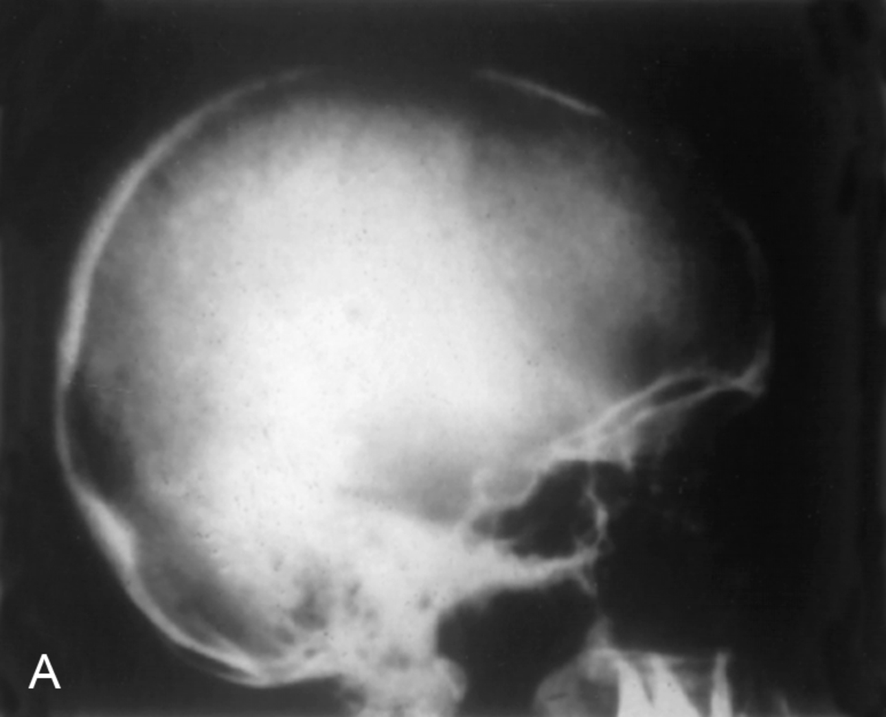 PHẪU THUẬT TUYẾN GIÁP VÀ TUYẾN CẬN GIÁP, ẤN BẢN THỨ 3. CHƯƠNG 53. CƯỜNG TUYẾN CẬN GIÁP TIÊN PHÁT: SINH LÝ BỆNH, CHỈ ĐỊNH PHẪU THUẬT VÀ THĂM KHÁM TRƯỚC MỔ