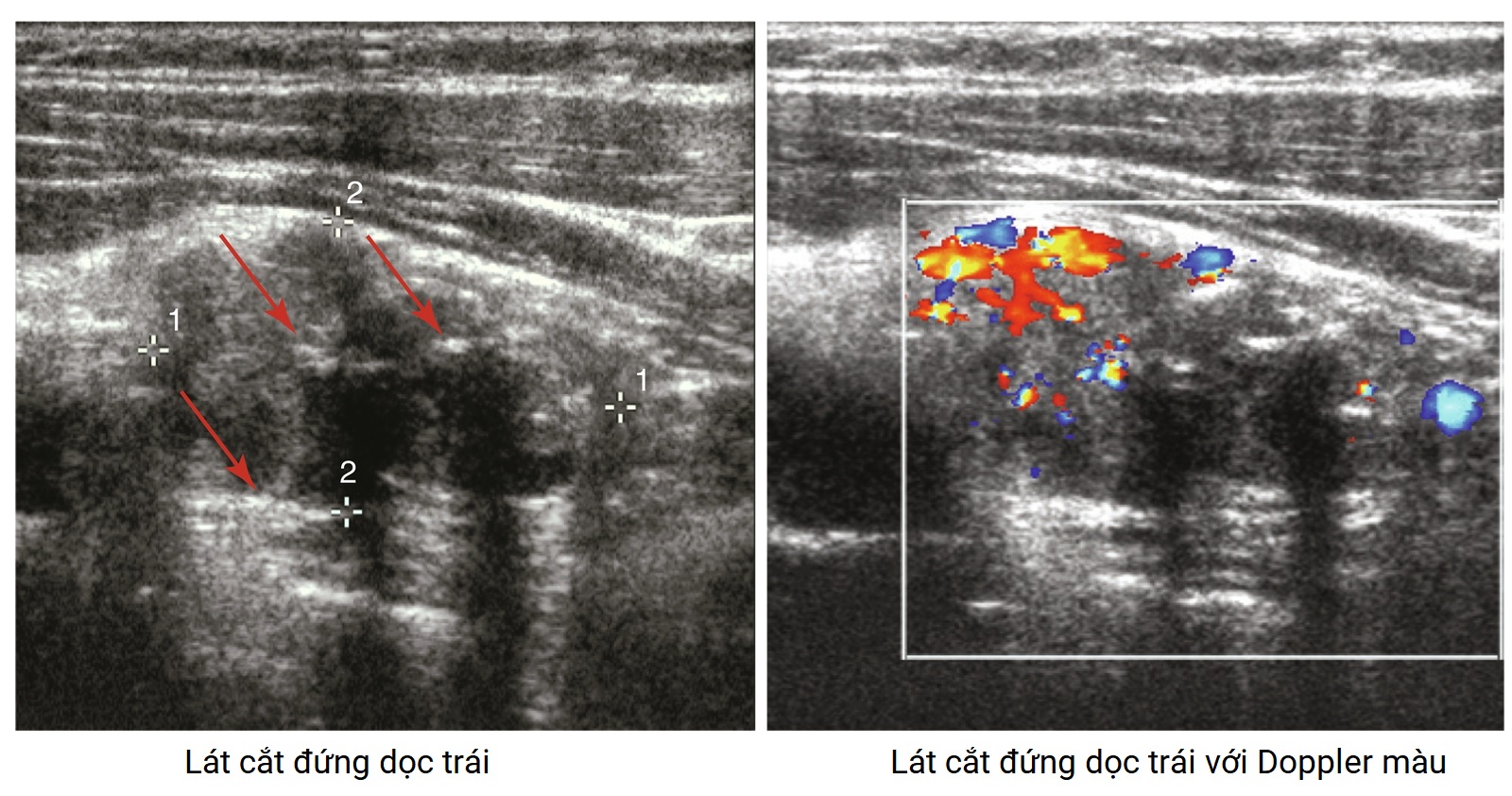 PHẪU THUẬT TUYẾN GIÁP VÀ TUYẾN CẬN GIÁP, ẤN BẢN THỨ 3. CHƯƠNG 54: HƯỚNG DẪN CÁC XÉT NGHIỆM CHẨN ĐOÁN HÌNH ẢNH ĐỊNH VỊ TUYẾN CẬN GIÁP TRƯỚC MỔ