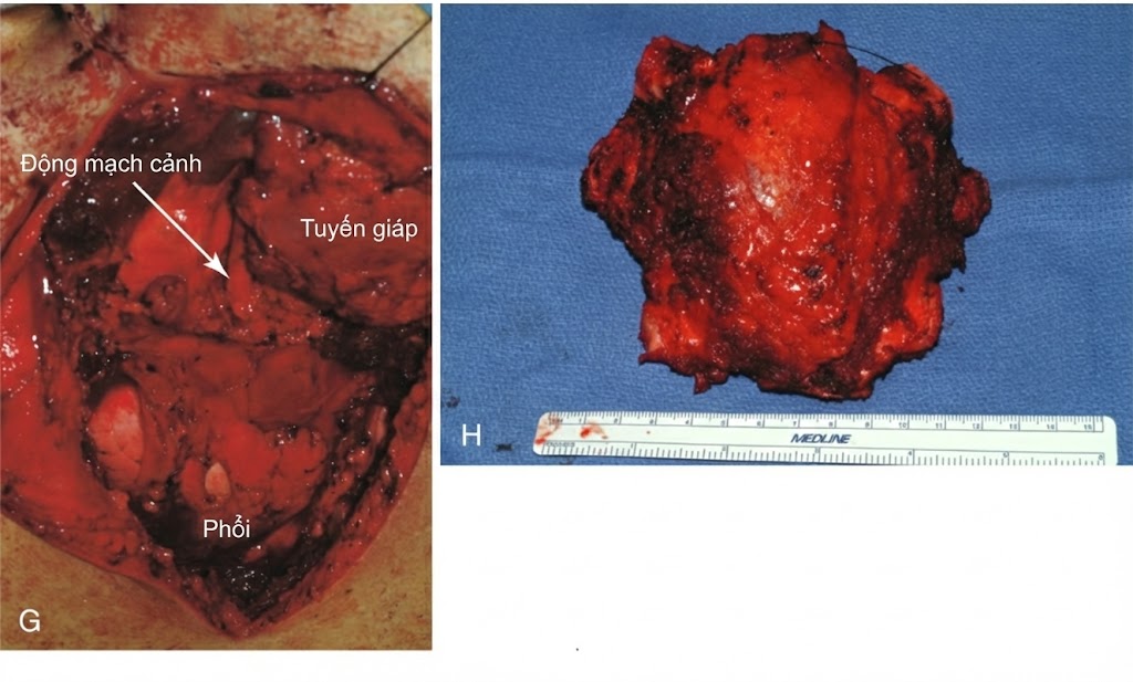 PHẪU THUẬT TUYẾN GIÁP VÀ TUYẾN CẬN GIÁP, ẤN BẢN THỨ 3. CHƯƠNG 37. PHẪU THUẬT UNG THƯ TUYẾN GIÁP TIẾN TRIỂN TẠI CHỖ: XÂM LẤN THANH QUẢN, KHÍ QUẢN VÀ THỰC QUẢN PHẪU THUẬT TUYẾN GIÁP VÀ TUYẾN CẬN GIÁP, ẤN BẢN THỨ 3. CHƯƠNG 37. PHẪU THUẬT UNG THƯ TUYẾN GIÁP TIẾN TRIỂN TẠI CHỖ: XÂM LẤN THANH QUẢN, KHÍ QUẢN VÀ THỰC QUẢN