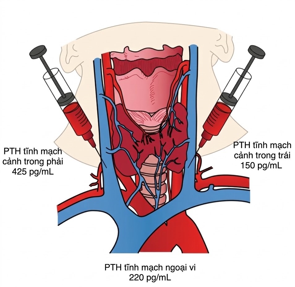 PHẪU THUẬT TUYẾN GIÁP VÀ TUYẾN CẬN GIÁP, ẤN BẢN THỨ 3. CHƯƠNG 59. THEO DÕI PTH TRONG MỔ TRONG PHẪU THUẬT TUYẾN CẬN GIÁP