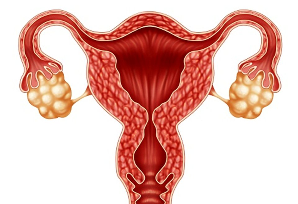 Cập nhật chẩn đoán và điều trị hội chứng buồng trứng đa nang