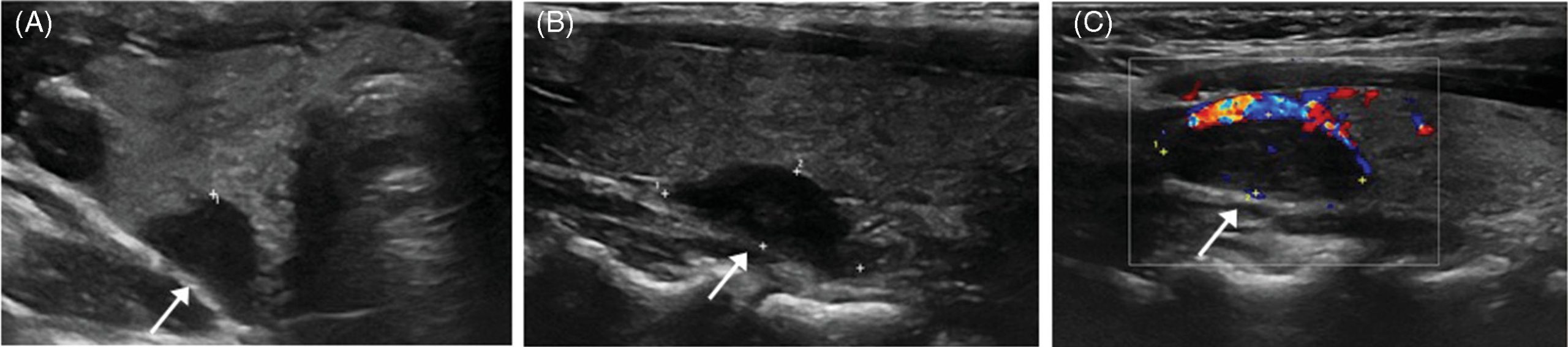 Sổ tay Hình ảnh học Nội tiết (2026). CHƯƠNG 3. CHẨN ĐOÁN HÌNH ẢNH BỆNH LÝ TUYẾN CẬN GIÁP