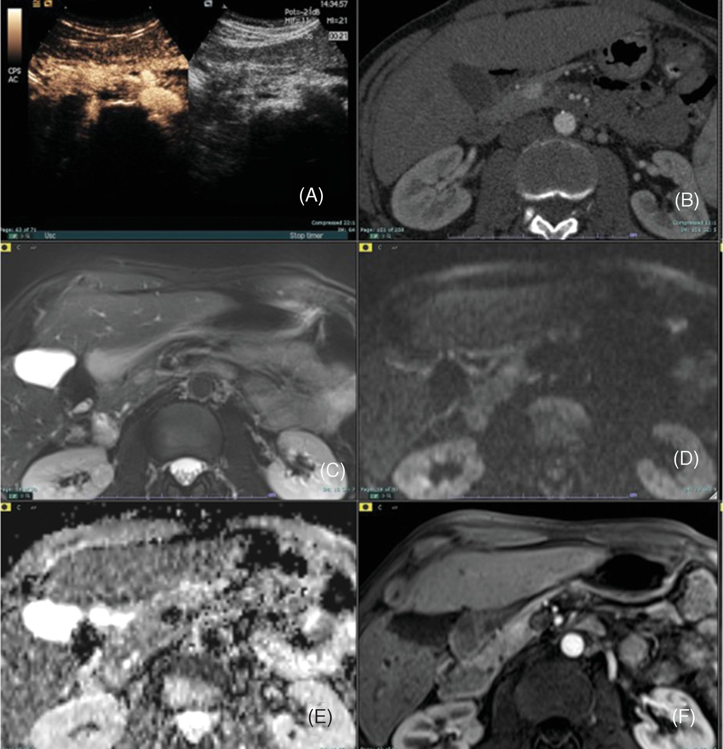 Sổ tay Hình ảnh học Nội tiết (2026). CHƯƠNG 4. KHỐI U THẦN KINH NỘI TIẾT TUYẾN TỤY