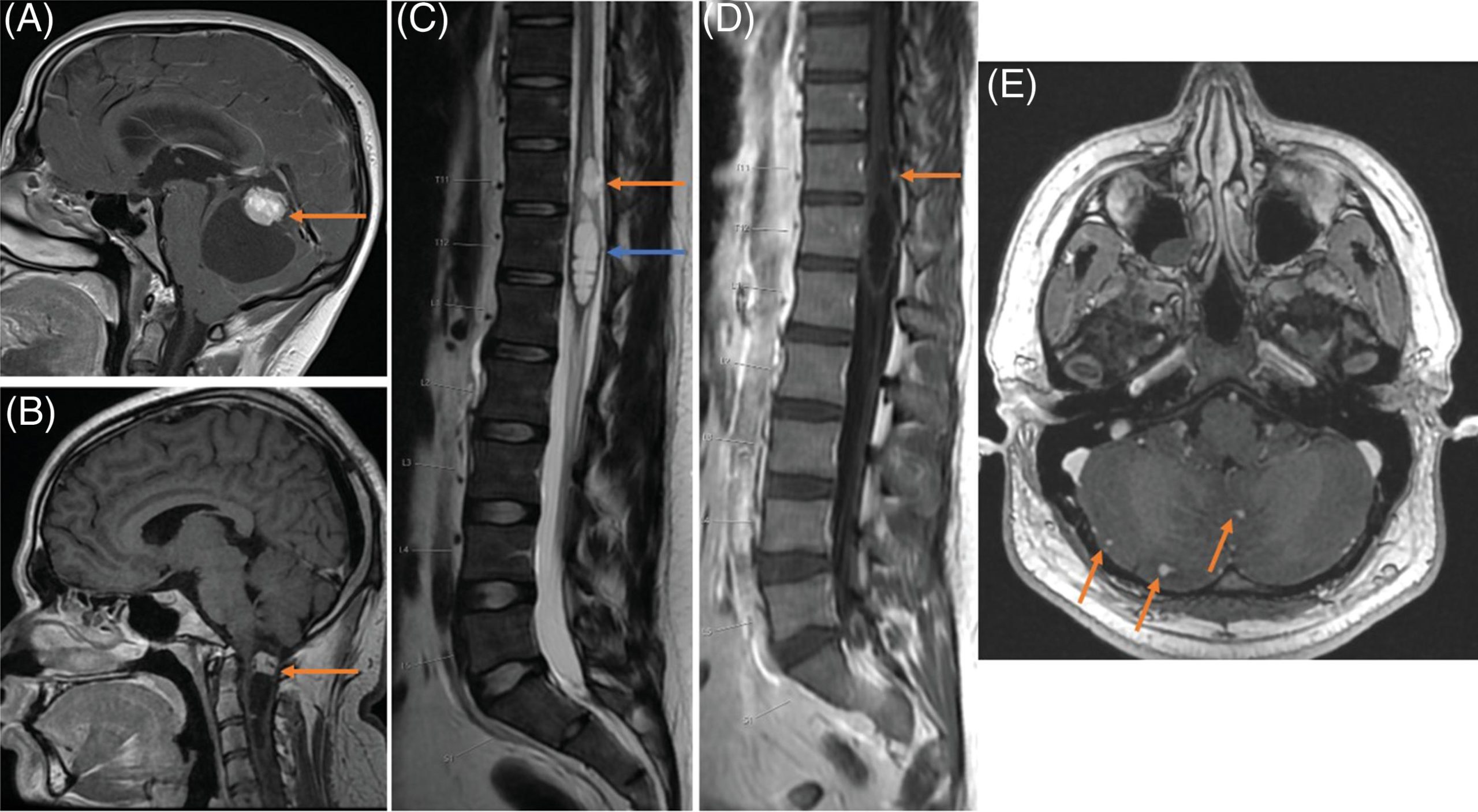 Sổ tay Hình ảnh học Nội tiết (2026). CHƯƠNG 5. HỘI CHỨNG VON HIPPEL-LINDAU
