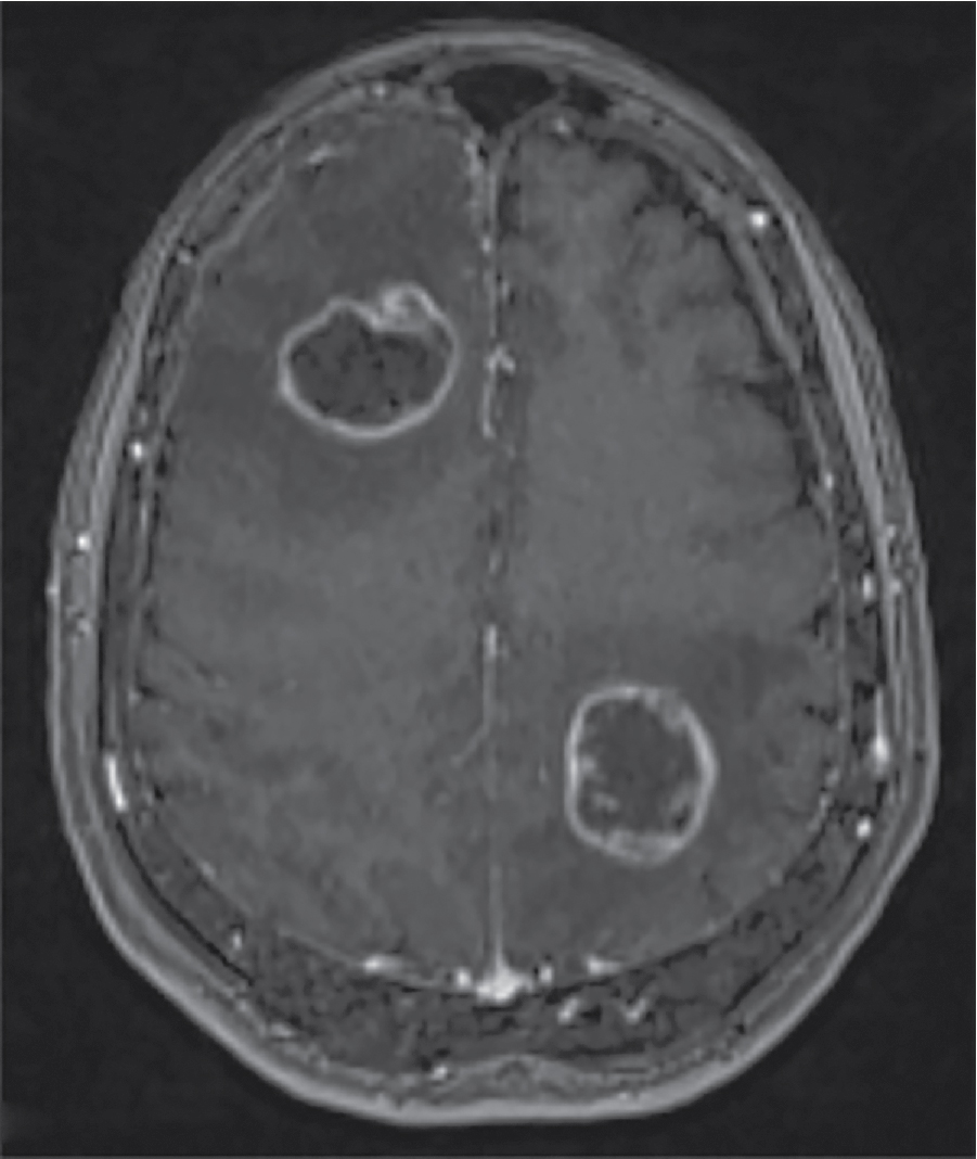 Ung thư Phổi – Cách tiếp cận Quản lý Đa ngành Dựa trên bằng chứng. CHƯƠNG 6. BỆNH LÝ DI CĂN ÍT