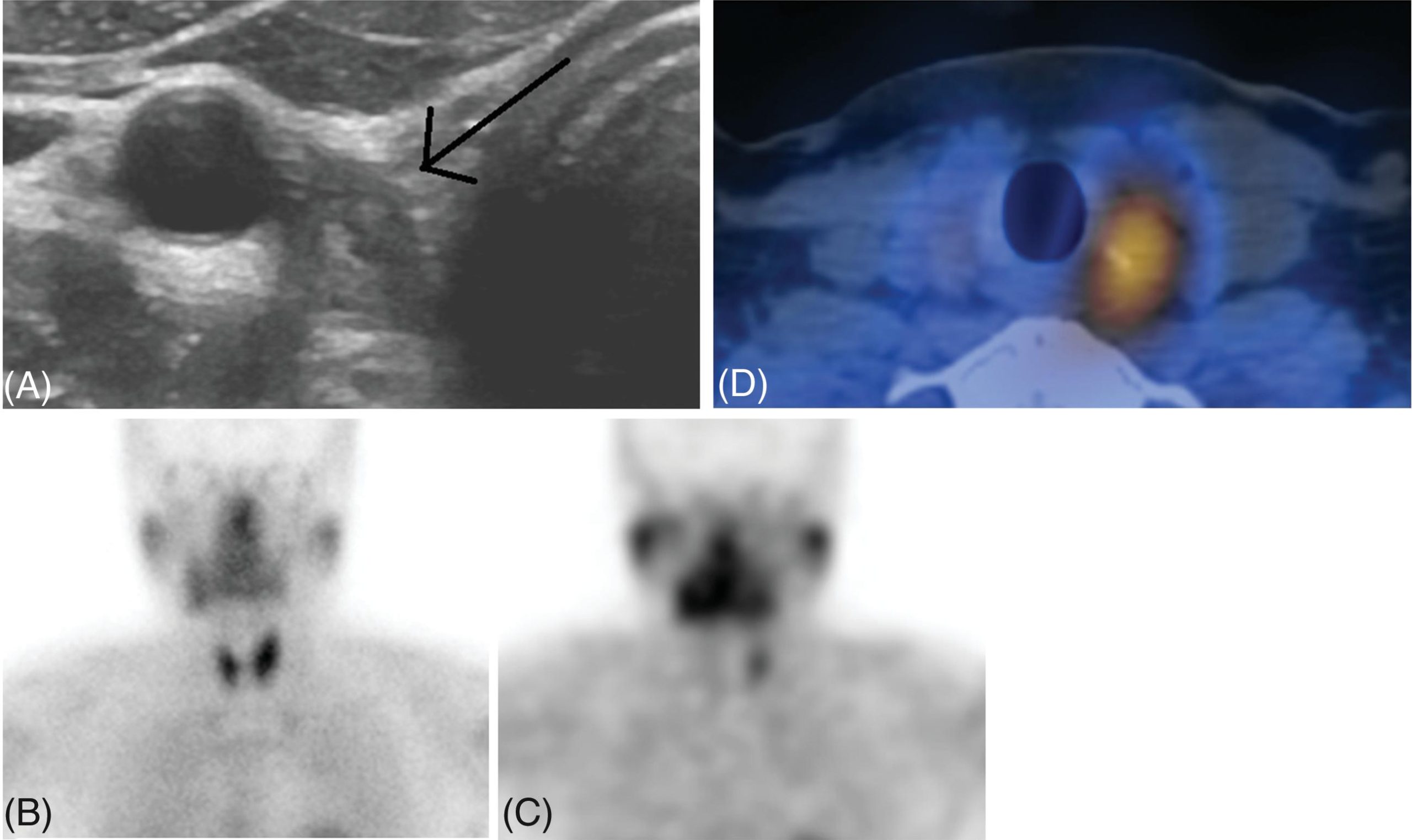 Sổ tay Hình ảnh học Nội tiết (2026). CHƯƠNG 6. ĐA U TÂN SINH TUYẾN NỘI TIẾT