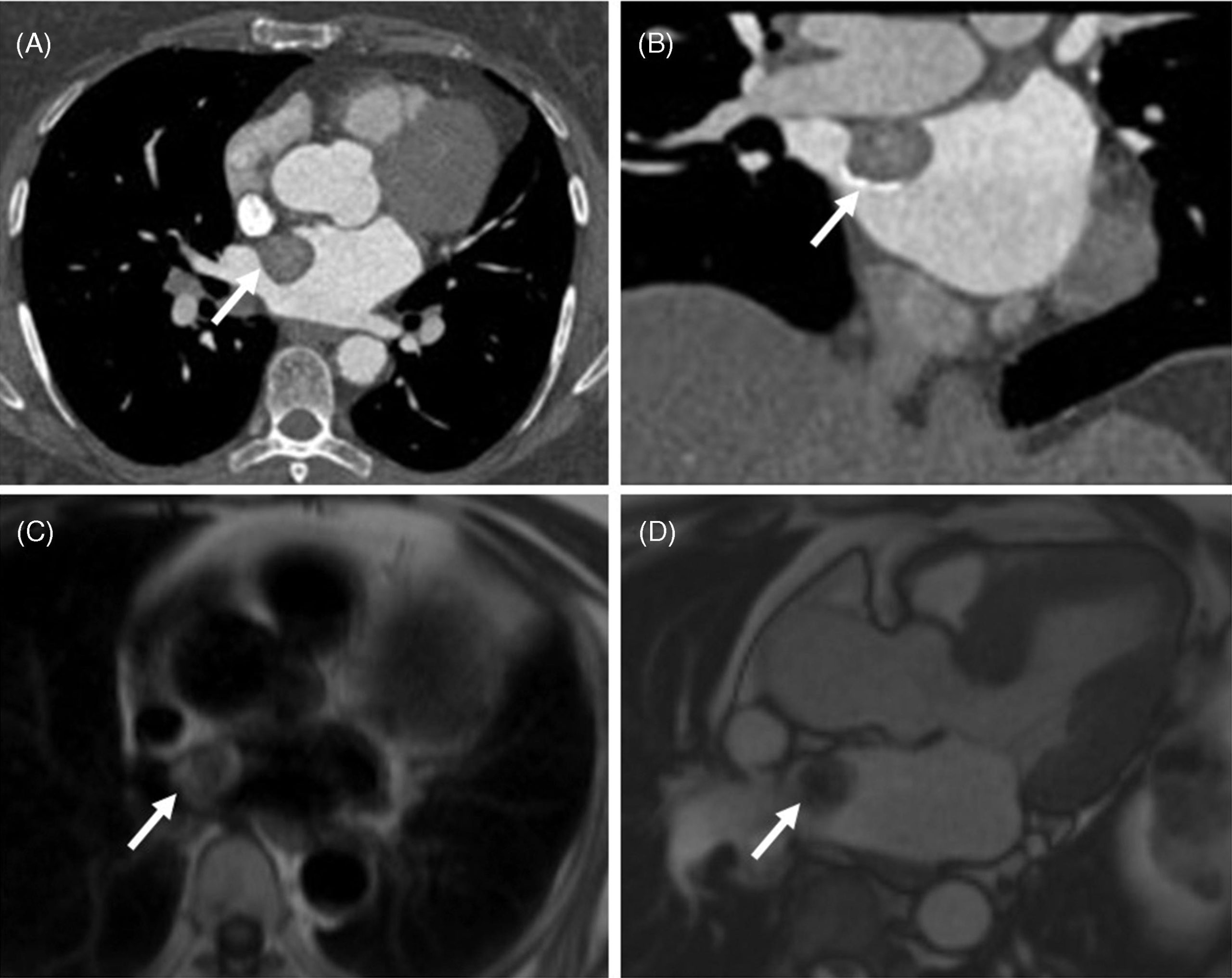Sổ tay Hình ảnh học Nội tiết (2026). CHƯƠNG 8. HỘI CHỨNG CARNEY (CARNEY COMPLEX)