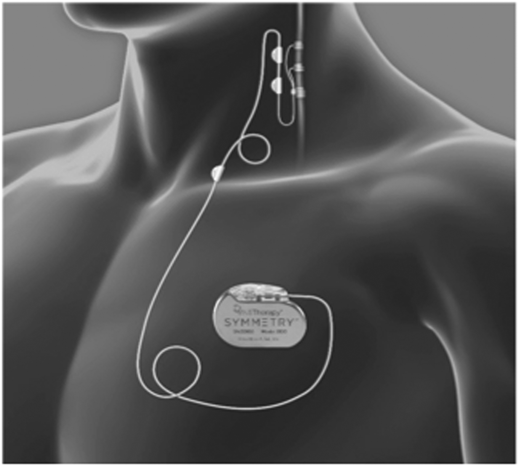 Điều trị Trầm cảm Kháng trị – Dược lý Thần kinh và Kích thích Thần kinh. CHƯƠNG 11: KÍCH THÍCH THẦN KINH PHẾ VỊ TRONG ĐIỀU TRỊ TRẦM CẢM KHÁNG TRỊ