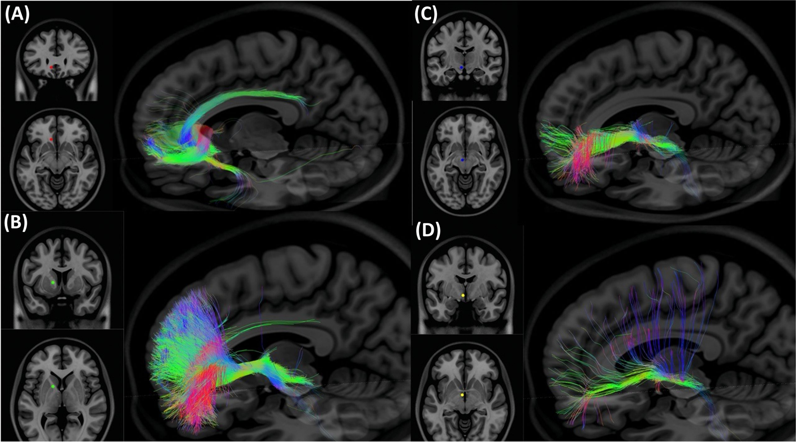 Điều trị Trầm cảm Kháng trị – Dược lý Thần kinh và Kích thích Thần kinh. CHƯƠNG 12: KÍCH THÍCH NÃO SÂU TRONG ĐIỀU TRỊ TRẦM CẢM KHÁNG TRỊ