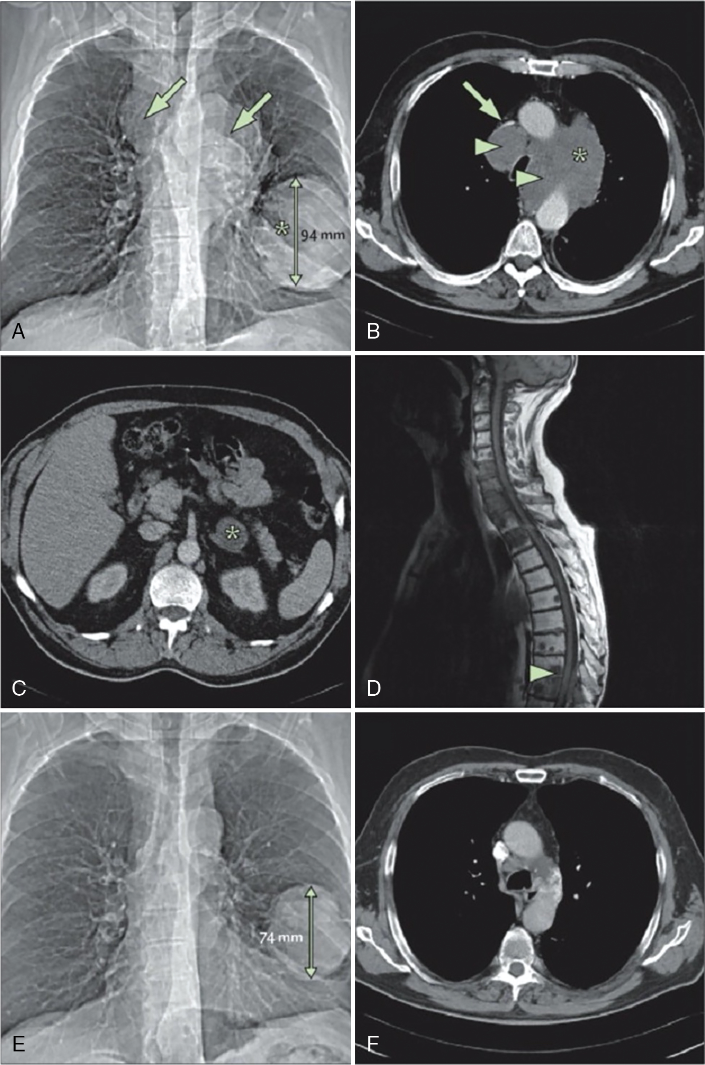Ung thư Phổi – Cách tiếp cận Quản lý Đa ngành Dựa trên bằng chứng. CHƯƠNG 14: UNG THƯ PHỔI TẾ BÀO NHỎ