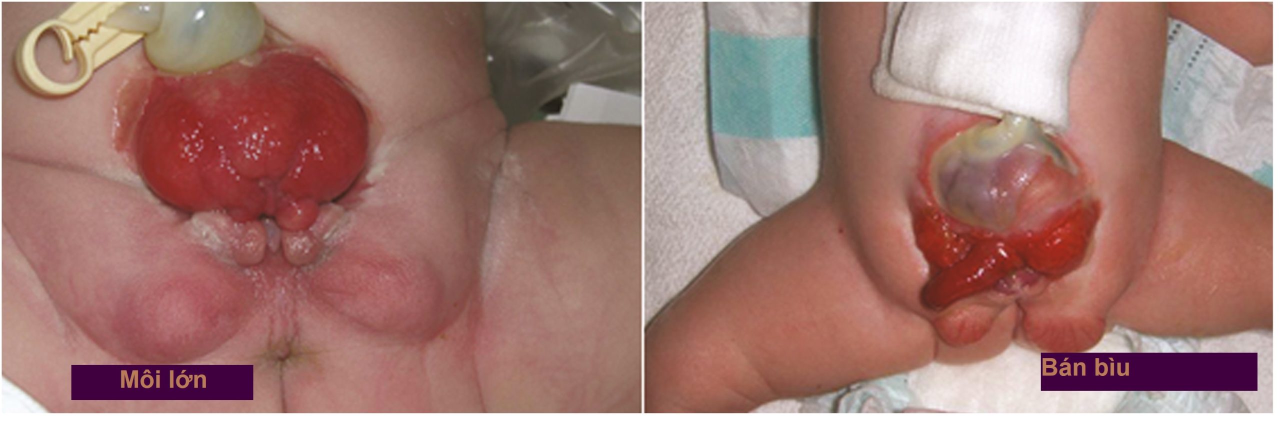 Nội tiết học Bà mẹ – Thai Nhi và Sơ Sinh (Ấn bản thứ 2, 2026). CHƯƠNG 48. RỐI LOẠN PHÁT TRIỂN GIỚI TÍNH