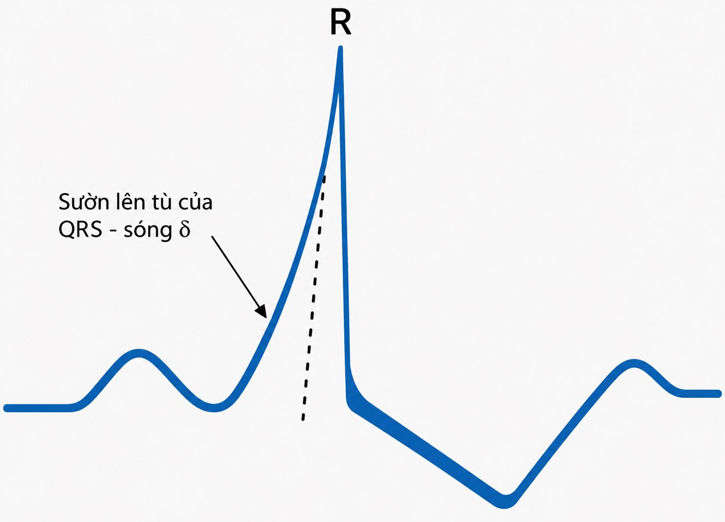 Cẩm nang Chăm sóc tích cực của OH, ấn bản thứ 9, 2026. CHƯƠNG 31. CÁC RỐI LOẠN NHỊP TIM (PHẦN 2/3)