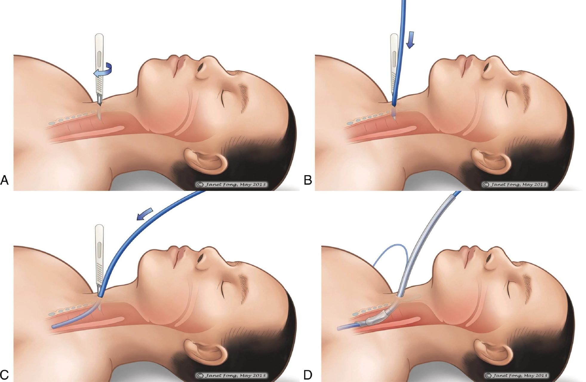 Cẩm nang Chăm sóc tích cực của OH, ấn bản thứ 9, 2026. CHƯƠNG 44. QUẢN LÝ ĐƯỜNG THỞ VÀ TẮC NGHẼN ĐƯỜNG THỞ CẤP TÍNH